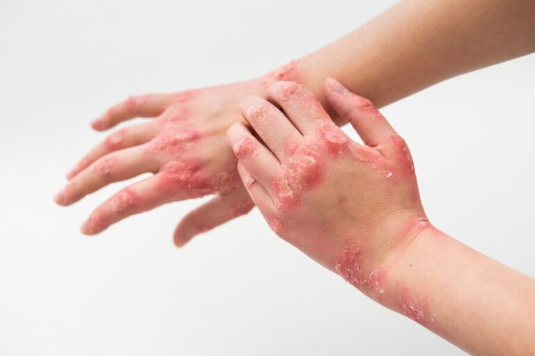 Best psoriasis treatment in dubai