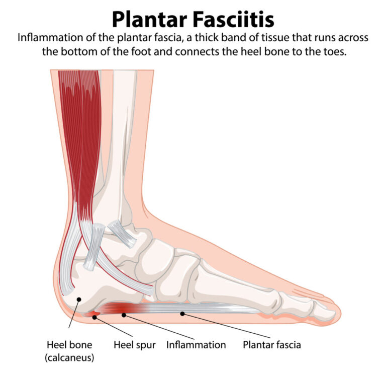 Plantar fasciitis treatment in dubai